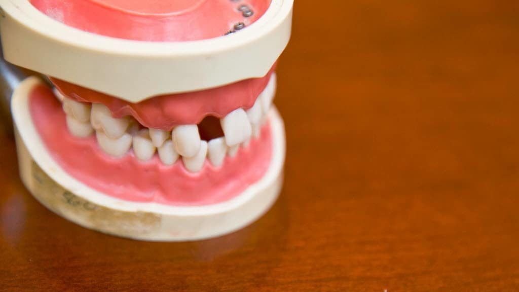 نکات مهم در مورد جراحی دندان عقل