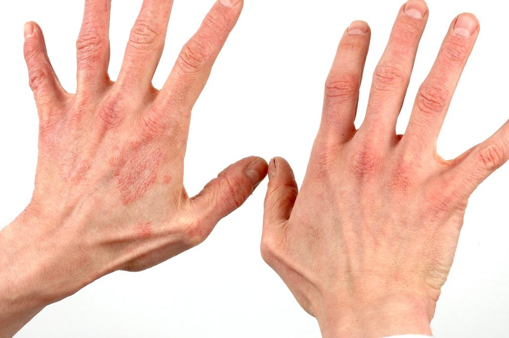 علائم مختلف بیماری روی دستان