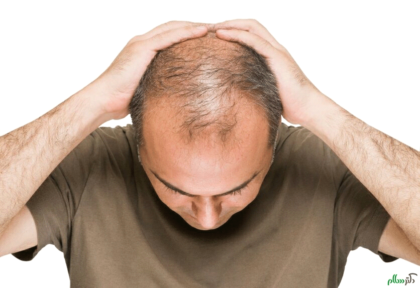  انواع بیماری های مو و درمان آن ها