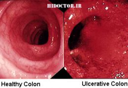 مقاله کامل بیماری کولیت اولسروز یا کولیت خونریزی‌دهنده