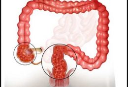 کاهش علایم و درمان بیماری کولیت اولسرو در ناحیه رکتوم