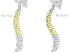 ناهنجاری ستون فقرات | پشت گرد (قوز) Kyphosis کایفوز