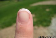 درمان پوسته پوسته شدن نوک انگشتان دست
