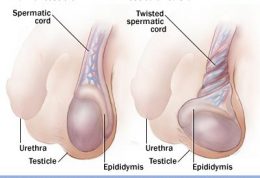 علت های درد در بیضه | درمان دردهای بیضه