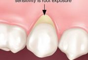 پیشگیری و درمان حساسیت دندان ها