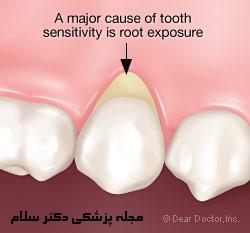 پیشگیری و درمان حساسیت دندان ها