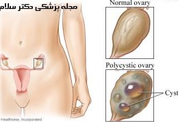 تخمدان پلی کیستیک | اختلال در قاعدگی، موی زاید