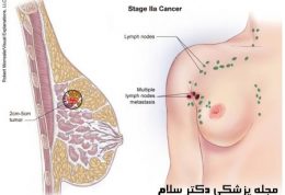 سرطان سینه و غدد لنفاوی و افزایش تومور