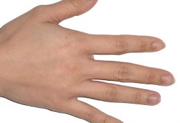 علت و درمان پوسته پوسته شدن دست ها