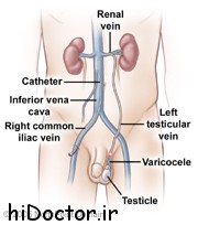 عوارض واريکوسل | روش های درمان و جراحی واريکوسل
