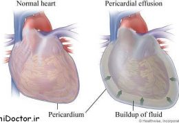 درباره معالجه پريكارديال افيوژن بیشتر بدانیم