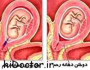 درباره دوختن دهانه رحم در زنان باردار بیشتر بدانیم