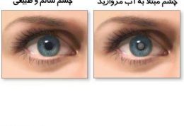 اطلاعات کامل درباره آب مروارید (Cataract)