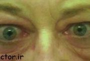 علتها و نشانه ها و روشهای درمانی تیروئید چشمی