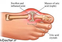 اطلاعات کامل درباره اسید اوریک بالا (High uric acid level)