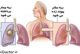 آنچه باید درباره پیوند ریه بدانیم