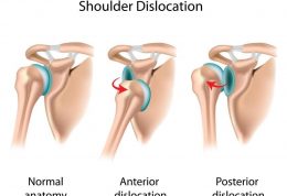 درباره بیشترین میزان دررفتگی مفصل شانه  چه میدانید