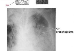 آشنایی با نمای Air Bronchogram