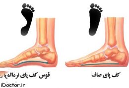 کف  پای صاف را چگونه درمان میکنند؟
