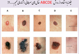 خودتان سرطان پوست را  بدون نیاز به پزشک تشخیص دهید
