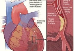 روش نوین برای تشخیص زود گرفتگی رگهای قلب