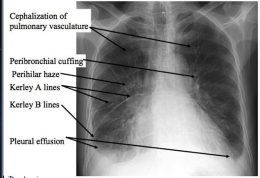 آموزش تشخیص ادم ریوی از روی رادیوگرافی