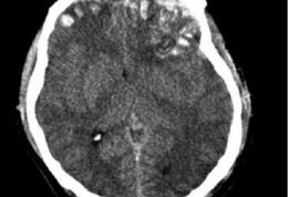 اقدامات اولیه پرستاران با  بیماران ضربه مغزی