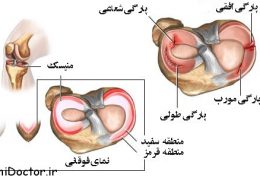 هر آنچه باید درباره آسیب های منیسک زانو بدانید