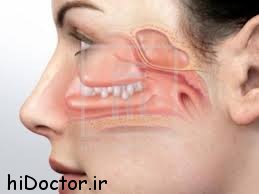 چای درمان کننده پولیپ بینی