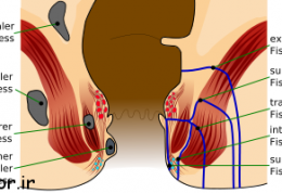 فیستول مقعدی چگونه درمان میشود
