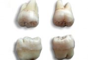 از کجا بدانیم چه زمانی باید دندان عقل را بکشیم؟