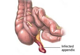 آپاندیسیت – نشانه ها، علائم، بهبود و خطرات