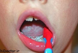 تاثیر مکمل آهن بر دندان کودکان