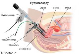 روش هیستروسکوپی – خطرات و عوارض جانبی