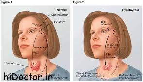 کم کاری تیروئید را باهم مرور میکنیم