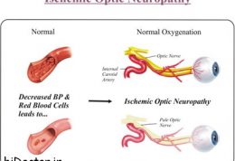 هر آنچه باید درباره آسیب عصب بینایی بدانیم