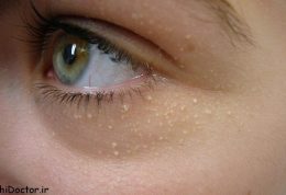 هر آنچه لازم است درباره درمان دانه های سفید اطراف چشم بدانیم