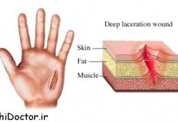 مراقبت از زخم – درمان، عفونت و عوارض