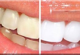 خود درمانی برای سفید کردن دندان موجب خرابی مینای دندا ن میشود