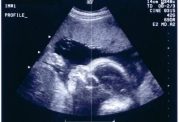 تاثیرات منفی سونوگرافی بر جنین
