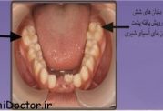 در دهان کودکان نخستین دندان آسیای بزرگ چقدر مهم است؟