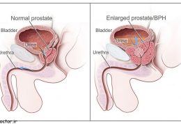 پروستات چه زمانی دچار هیپرپلازی خوش‌خیم می شود