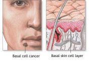 درباره بیماری پوستی کارسینوم سلول بازال چقدر میدانید