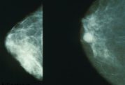 ماموگرافی به چه منظوری استفاده میشود