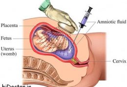 روش آمنیوسنتز / آزمون و خطرات