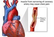 درمان و علائم درد قلبی ناشی از آنژین صدری