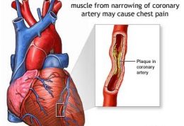 درمان و علائم درد قلبی ناشی از آنژین صدری