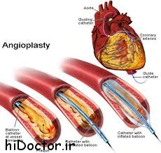 روش آنژیوپلاستی خطرات ناشی از  عوارض آن
