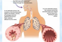 علائم و نشانه های آسم و راه های تشخیصی