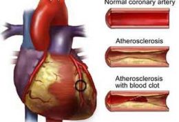 تعریف آترواسکلروز ، علائم و درمان